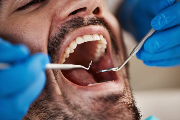 Best Emergency Dentist for Lost Fillings or Crowns in Bellefonte, PA